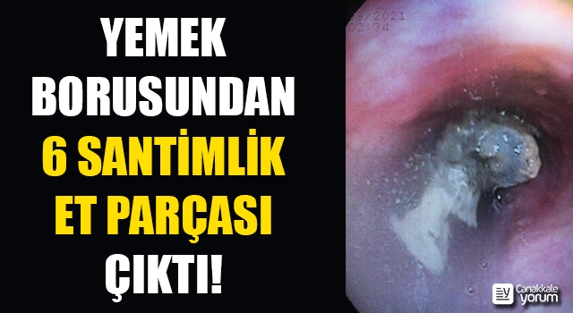 Yemek borusundan 6 santimlik et parçası çıktı!