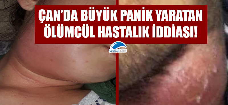 Çan'da büyük panik yaratan ölümcül hastalık iddiası! Tularemi hastalığı nedir?